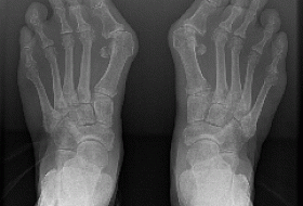 Hallux Valgus или почему растет косточка на большом пальце? Hallux Valgus или почему растет косточка на большом пальце?